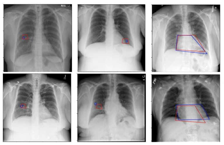 Object detection application in Healthcare